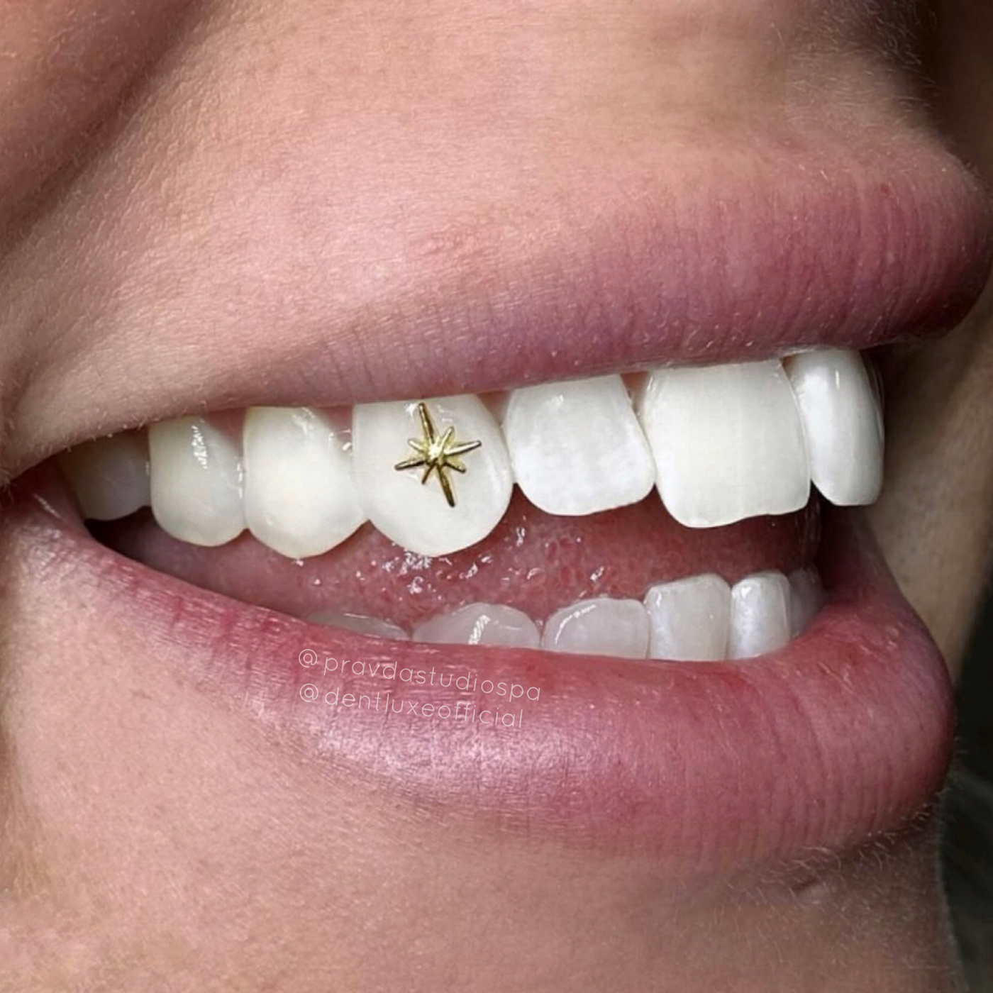 Diamond 2 Gold Tooth Gem